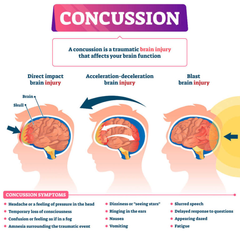 Concussion and PostConcussion Syndrome Charlie Waters Law