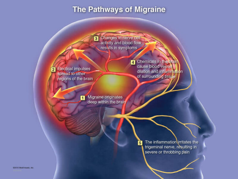 Post-Traumatic Headaches after Brain Injury - Charlie Waters Law