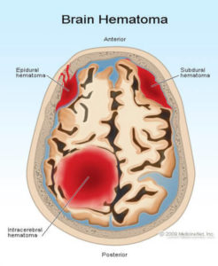 Primary Brain Injuries - Charlie Waters Law